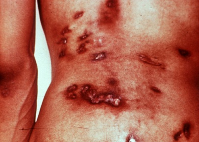 Coccidioidal granuloma - Hình ảnh minh họa